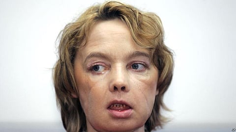 Isabelle Dinoire,world’s first partial face transplant recipient dies due to cancer