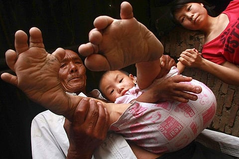 Man suffering from Local Gigantism dubbed as ‘Devil’ by his Own Family