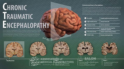 Neuropathologists confirm brain disease CTE as unique