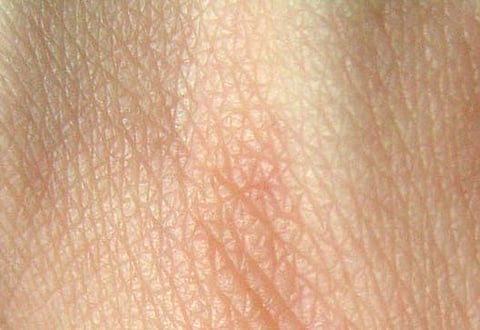 त्वचा की समस्या का उपाय कच्चा दूध (Wikimedia)