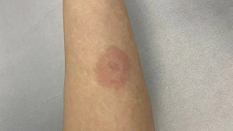 Lyme disease : लाइम रोग एक प्रकार का संक्रमण है, जो बोरेलिया बैक्टीरिया वाले टिक के काटने से फैलता है। (Wikimedia Commons)