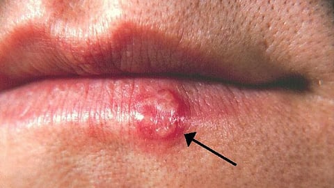 Herpes : यह सामान्य संक्रमण है, जिसमें दर्दनाक छाले या अल्सर बन जाते है। (Wikimedia Commons)