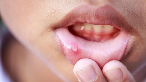 नारियल तेल से लेकर हल्दी तक, मुंह के छालों से देंगे आराम