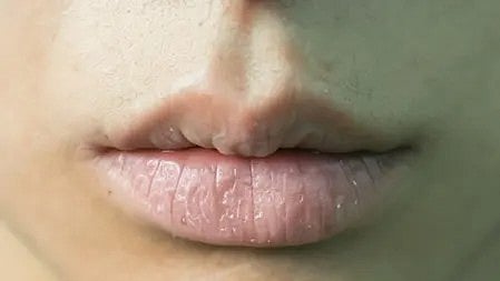 सर्दियों में सूखे होंठ वाली लड़की|