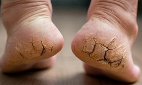 फटी एड़ियों की तस्वीर