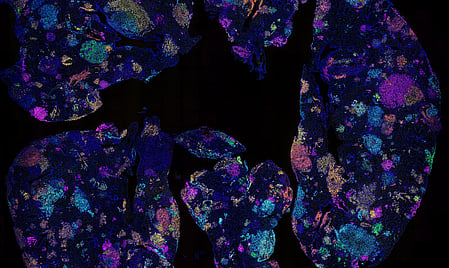 Australian study on lung cancer