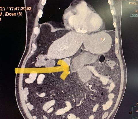 स्टेरॉयड के उपयोग करने वाले मरीज और अनियंत्रित मधुमेह से पीड़ित मरीजों में ज्यादातर फंगस से ग्रहसित हो रहे हैं। (सोशल मीडिया)
