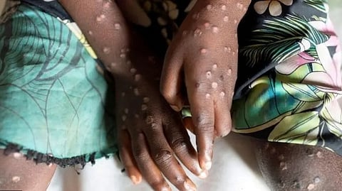 കുരങ്ങ് പനി: ആഫ്രിക്കയില് ആരോഗ്യ അടിയന്തരാവസ്ഥ; മരുന്നിനും ക്ഷാമം