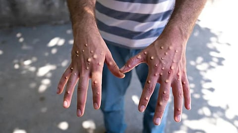 എംപോക്സ് തീവ്ര വ്യാപനം; ആഗോള ആരോഗ്യ അടിയന്തരാവസ്ഥ പ്രഖ്യാപിച്ച് ലോകാരോഗ്യ സംഘടന