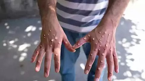 എംപോക്സിൻ്റെ തീവ്രവകഭേദം ആഫ്രിക്കയ്ക്ക് പുറത്തും