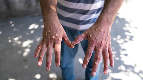 മങ്കി പോക്സ് ഏഷ്യയിലേക്കും പടരുന്നു; പാകിസ്ഥാനിൽ ഒരു രോഗബാധിതനെ കണ്ടെത്തി