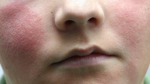 മുഖത്ത് ചുണങ്ങുകളും ചുവന്നുവീര്ത്ത പാടുകളും; യുഎസ്സില് ആശങ്ക പരത്തി സ്ലാപ്പ്ഡ് ചീക്ക് വൈറസ്