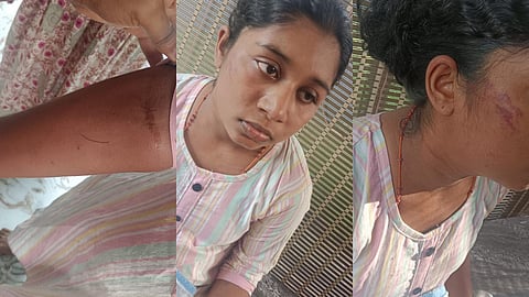 കുഞ്ഞിന് പാൽ നൽകിയില്ല; കൊല്ലത്ത് 19കാരിയായ അമ്മയ്ക്ക് ഭർതൃവീട്ടുകാരുടെ ക്രൂരമർദനം