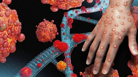 എംപോക്സ്: ലക്ഷണങ്ങൾ എന്തൊക്കെ? എന്തൊക്കെ കരുതല് വേണം? അറിയേണ്ടതെല്ലാം
