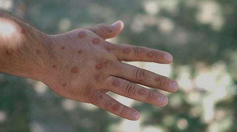 എം പോക്സ്: മഞ്ചേരി മെഡിക്കൽ കോളേജിൽ പ്രവേശിപ്പിച്ച യുവാവിൻ്റെ സ്രവ പരിശോധന ഫലം ഇന്ന് വരും