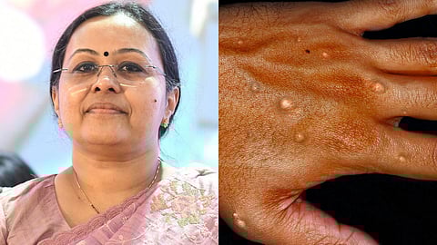 എംപോക്സ്: സംസ്ഥാനത്ത് ജാഗ്രത നിർദേശം പുറപ്പെടുവിച്ച് ആരോഗ്യവകുപ്പ്