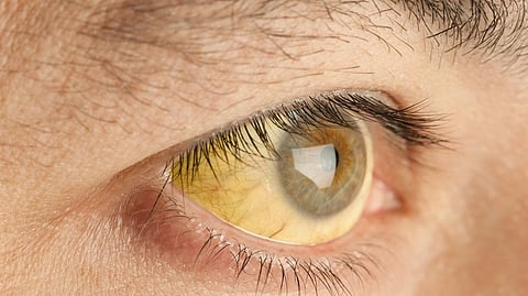 കോഴിക്കോട് പേരാമ്പ്രയിൽ മഞ്ഞപ്പിത്ത വ്യാപനം; രോഗം ബാധിച്ചവരിൽ ഭൂരിഭാഗവും വിദ്യാർഥികൾ