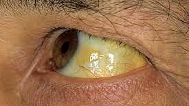 കോഴിക്കോട് ജില്ലയിൽ മഞ്ഞപ്പിത്തം വ്യാപിക്കുന്നു; ഒന്നര മാസത്തിനിടെ രോഗം സ്ഥിരീകരിച്ചത് 400 പേർക്ക്