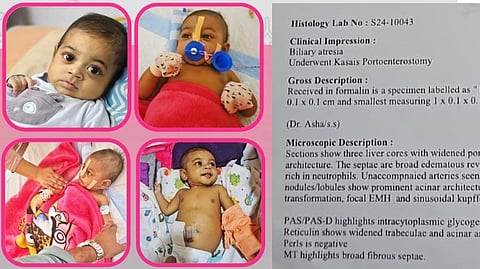 അപൂര്വ കരള്രോഗവുമായി ആറ് മാസം പ്രായമുള്ള കുഞ്ഞ്; ചികിത്സയ്ക്ക് വേണ്ടത് 35 ലക്ഷം, സുമനസുകള് കൈവിടരുത്