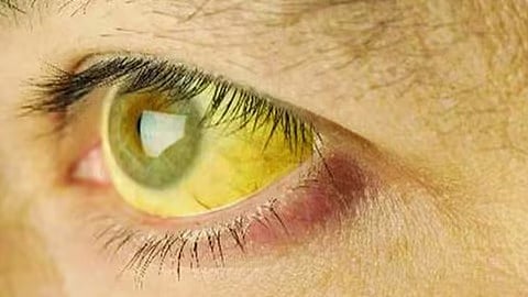 കോഴിക്കോട് ചങ്ങരോത്ത് മഞ്ഞപ്പിത്ത ബാധിതർ 310 ആയി; രോഗബാധിതരിൽ ഭൂരിഭാഗവും വിദ്യാർഥികൾ