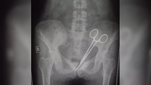 12 വർഷമായി തുടരുന്ന വയറുവേദനയുടെ കാരണം കണ്ടെത്താനാവാതെ ഡോക്ടർമാർ: ഒടുവിൽ വയറിനുള്ളിൽ നിന്നും കണ്ടെത്തിയത് കത്രിക