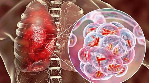 കൊവിഡ് മഹാമാരിയേയും പിന്തള്ളി; ഏറ്റവും മാരകരോഗമായി ക്ഷയരോഗം മാറുന്നു, കണക്കുകൾ പുറത്തുവിട്ട് ലോകാരോഗ്യസംഘടന