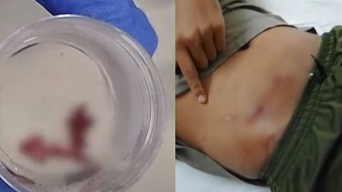 കോലഞ്ചേരി എംഒഎസ്സി മെഡിക്കല് കോളേജില് ചികിത്സാ പിഴവ്; അപ്പെന്ഡിസൈറ്റിസ് ശസ്ത്രക്രിയ നടത്തിയിട്ട് ബാക്കി ഭാഗം വയറില് തന്നെ