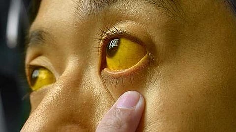 കളമശേരിയിൽ മഞ്ഞപ്പിത്ത ബാധിതരുടെ എണ്ണത്തിൽ വൻ വർധന; ഇതുവരെ സ്ഥിരീകരിച്ചത് 60ലധികം പേർക്ക്