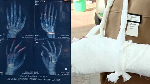 കൊച്ചിയിൽ കൊടും ക്രൂരത; സ്കോളിയോസിസ് രോഗിയായ 17 വയസുകാരൻ്റെ കൈ തല്ലിയൊടിച്ച് പൊലീസ്