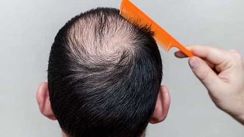 ബുൽധാനയിലെ അസാധാരണ മുടികൊഴിച്ചിൽ: അപൂർവ രോഗം ബാധിച്ചവരുടെ രക്തത്തിൽ സെലിനിയം കൂടുതലെന്ന് കണ്ടെത്തൽ