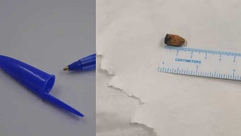 അഞ്ചാം വയസ്സില് വിഴുങ്ങിയ പേനയുടെ അടപ്പ്; ശ്വാസകോശത്തില് നിന്നും പുറത്തെടുത്തത് 21 വര്ഷങ്ങള്ക്കു ശേഷം