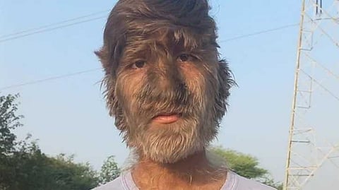 മുഖം മുഴുവന് രോമം; 'വേര്വൂള്ഫ് സിന്ഡ്രോം' ബാധിതനായ ഇന്ത്യന് യുവാവിനെ തേടി ഗിന്നസ് റെക്കോർഡ്