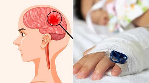 കളമശേരിയില് രണ്ടാം ക്ലാസ് വിദ്യാര്ഥിക്ക് മെനിഞ്ചൈറ്റിസ്; രോഗലക്ഷണങ്ങളോടെ ആറ് കുട്ടികള് നിരീക്ഷണത്തില്