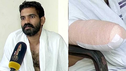 കുളം വ്യത്തിയാക്കുന്നതിനിടെ മീൻ കുത്തി; കണ്ണൂരിൽ കർഷകന്റെ കൈപ്പത്തി മുറിച്ച് മാറ്റി