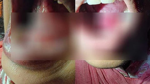 ആലത്തൂർ ഡെൻ്റൽ ക്ലിനിക്കിൽ ഗുരുതര ചികിത്സാ പിഴവ്; ഡ്രില്ലർ തട്ടി യുവതിയുടെ നാവിനടിയിൽ തുള വീണു