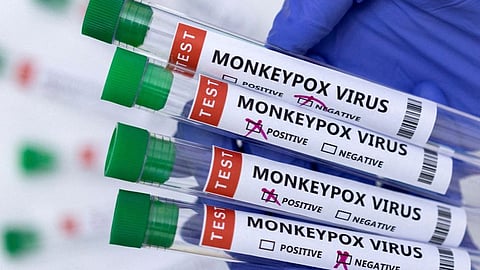 ஒரே சமயத்தில் கோவிட், குரங்கம்மை மற்றும் HIV நோயால் பாதிக்கப்பட்ட நபர்