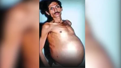 36 ஆண்டுகளாக வயிற்றில் இரட்டை சகோதரரை சுமந்த ஆண்; மருத்துவர்கள் அதிர்ச்சி! என்ன நடந்தது?
