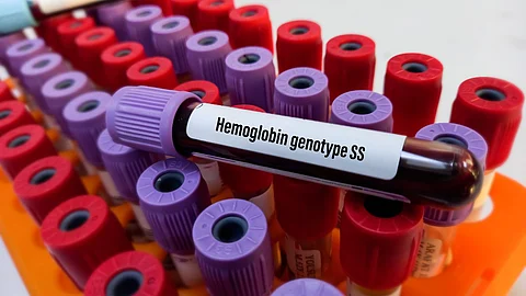 How to increase hemoglobin: Home remedies
