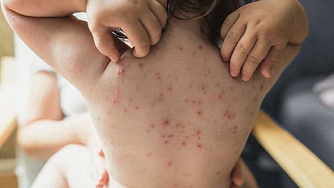কলকাতায় ছড়াচ্ছে চিকেন পক্স, একমাসে মৃত ৭ - জানুন ডাক্তারদের পরামর্শ