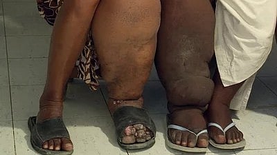 গোদের প্রকোপ বাড়ছে দেশজুড়ে