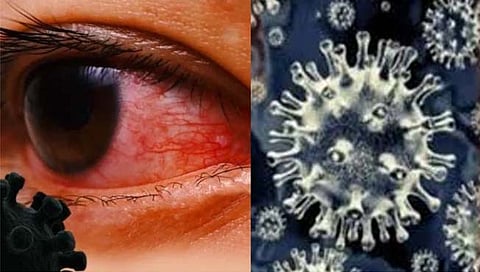 म्युकर मायकोसिस