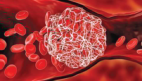 रक्ताच्या गुठळ्या होण्याची कारणे व त्याचे परिणाम