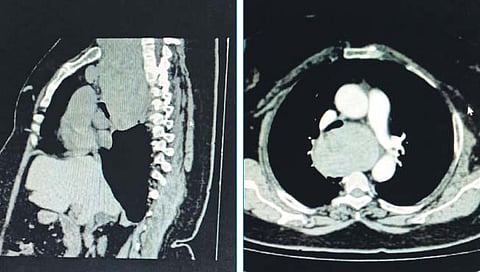 मुंबई : छातीपर्यंत पोहोचलेल्या रेस्ट्रोस्टर्नल थायरॉईडवर यशस्वी शस्त्रक्रिया