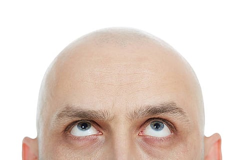 Men's baldness : पुरुषांना टक्कल का पडतं?