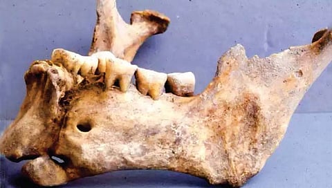 ग्रीक दंतवैद्य सोन्याच्या तारेने जोडत होते तुटलेला जबडा