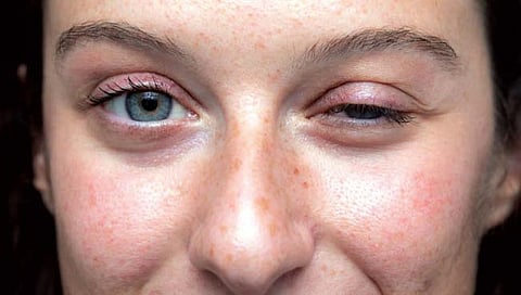 म्यास्थिनिया : एक धोकादायक आजार