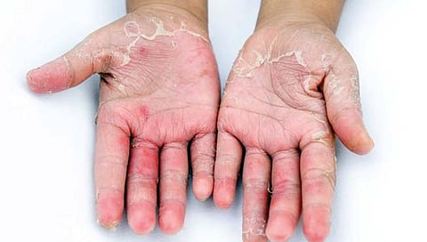 हाता-पायांची आग होत असल्यास…