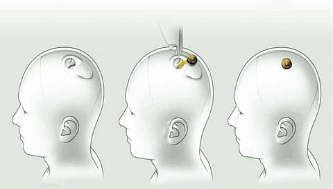 न्यूयॉर्क : आता मानवी मेंदूतही बसवली जाणार चिप