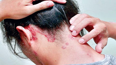 स्काल्प सोरायसीस ची समस्या