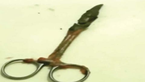 वीस वर्षांपासून पोटात होती कात्री